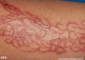 henna tattooing dermatitis