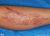 henna tattooing dermatitis