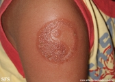 henna tattooing dermatitis