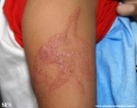 henna tattooing dermatitis