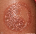 henna tattooing dermatitis