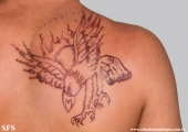 henna tattooing dermatitis