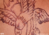 henna tattooing dermatitis