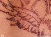 henna tattooing dermatitis