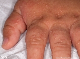 acropustulosis infantile