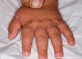 acropustulosis infantile