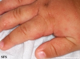 acropustulosis infantile