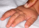 acropustulosis infantile