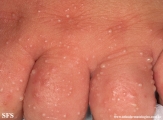 acropustulosis infantile