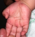 acropustulosis infantile