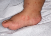 acropustulosis infantile