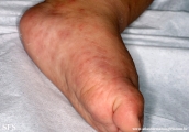 acropustulosis infantile