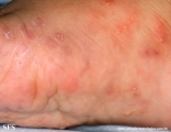 acropustulosis infantile