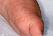 acropustulosis infantile