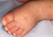 acropustulosis infantile