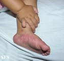 acropustulosis infantile
