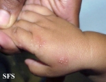 acropustulosis infantile