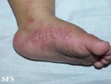 acropustulosis infantile