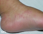 acropustulosis infantile