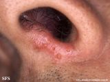 herpes simplex