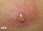 herpes simplex