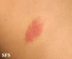 herpes simplex