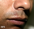 herpes simplex