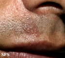 herpes simplex