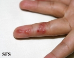 herpes simplex
