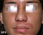 herpes simplex