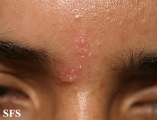 herpes simplex