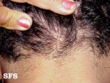 folliculitis cheloidalis