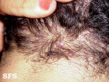 folliculitis cheloidalis