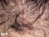 folliculitis cheloidalis