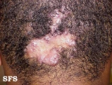 folliculitis cheloidalis