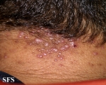 folliculitis cheloidalis