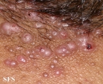 folliculitis cheloidalis