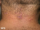 folliculitis cheloidalis