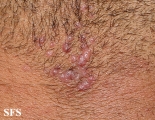 folliculitis cheloidalis