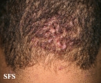 folliculitis cheloidalis