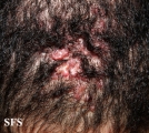 folliculitis cheloidalis