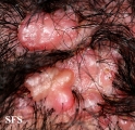 folliculitis cheloidalis