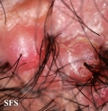 folliculitis cheloidalis