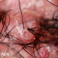 folliculitis cheloidalis