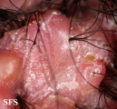folliculitis cheloidalis