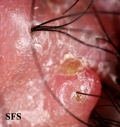 folliculitis cheloidalis