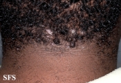 folliculitis cheloidalis