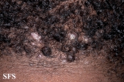 folliculitis cheloidalis