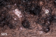 folliculitis cheloidalis