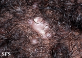 folliculitis cheloidalis